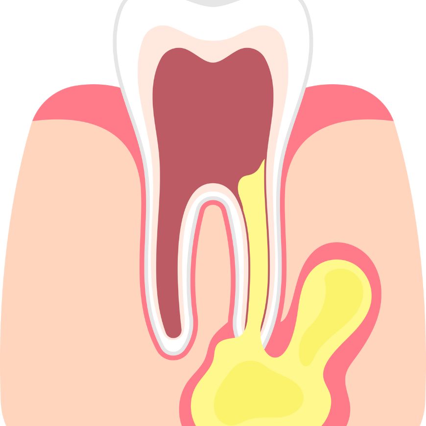 Dent Infectée : traitement de canal ou extraction dentaire ?